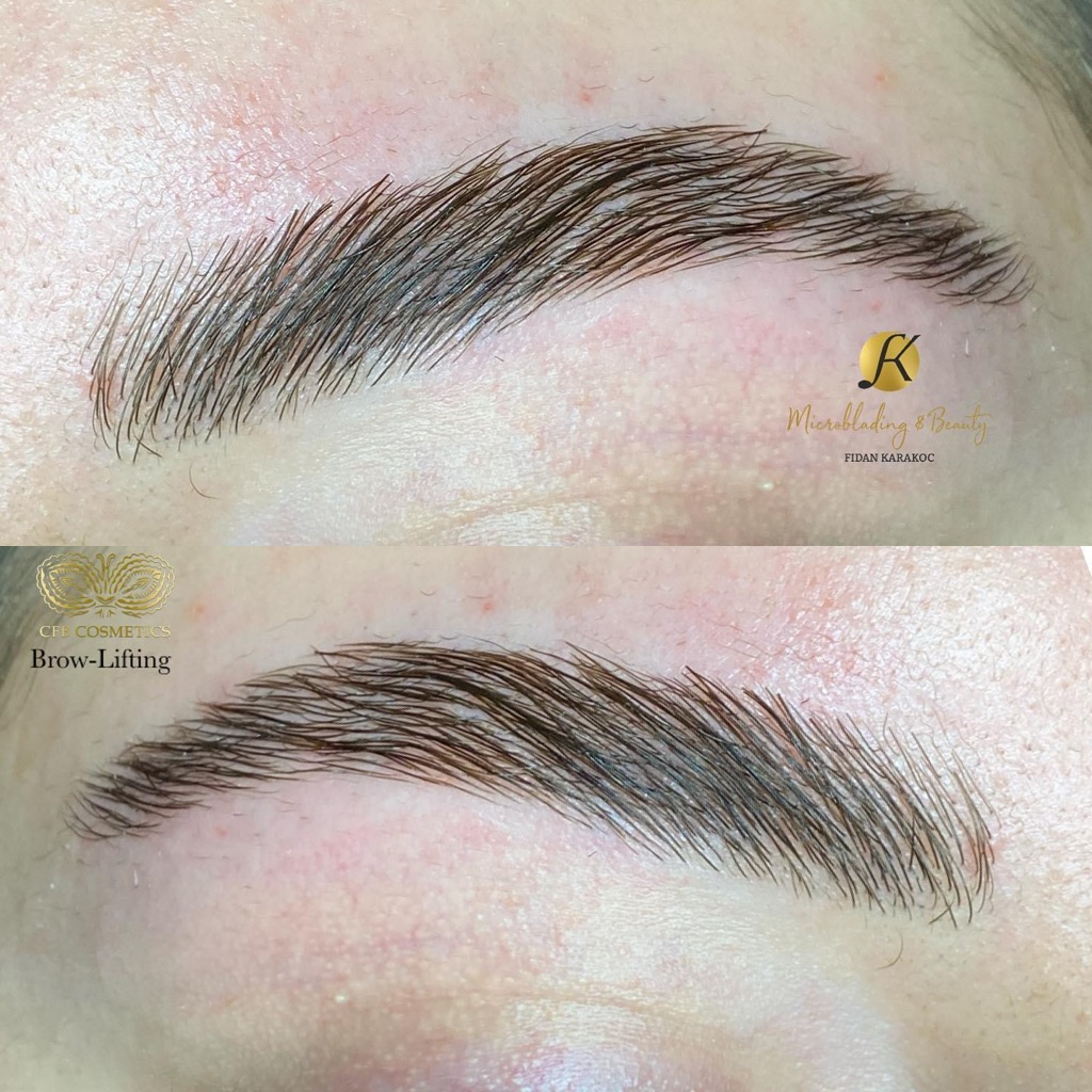 Brow Lifting